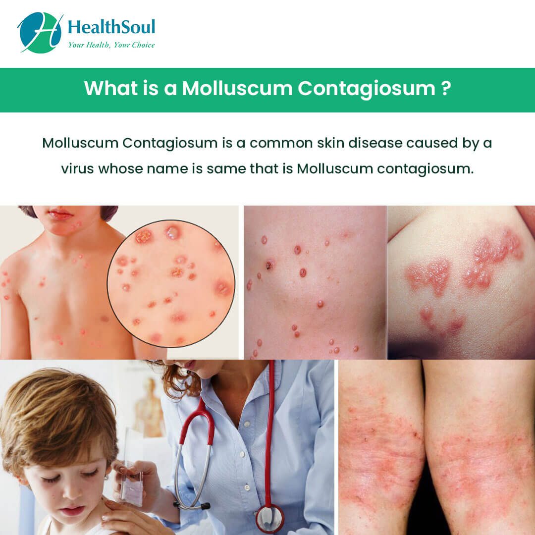 molluscum contagiosum in children